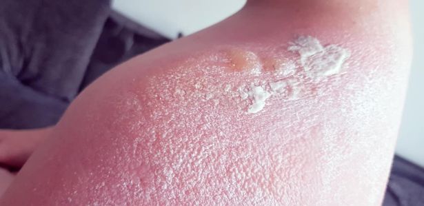 mom shares photos of son's third degree burns