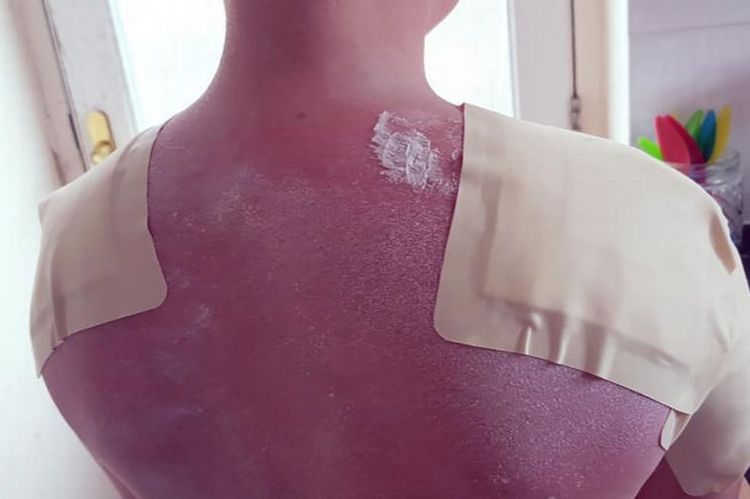 sunscreen warning: mom shares photos of son's third-degree sunburns as a warning to families