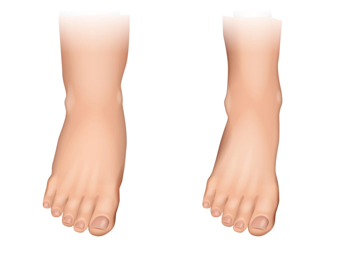 swollen feet? read about 8 medical conditions that can cause feet to swell up | when people think of swollen feet, most consider the most common causes for the symptom: pregnancy, injury, or a job that requires a lot of walking. but many get swollen feet when these things aren’t the case. in those situations, what’s the cause?