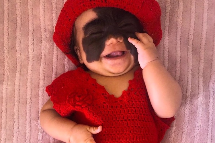 Luna Fenner: 6-Month-Old American to Have Batman-Shaped Face Patch Removed in Series of Surgeries in Russia