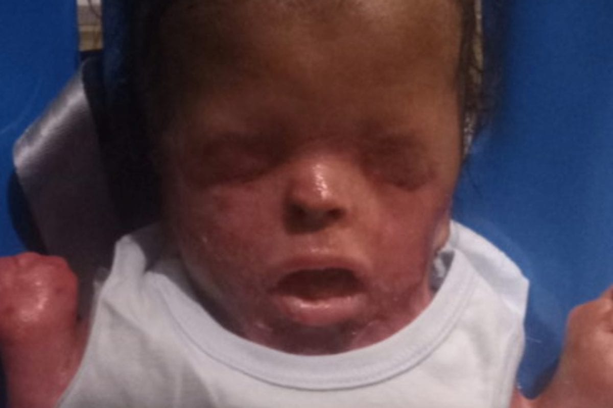 Ten Months After Baby Boy Was Born Without Skin, His Mom Is Finally Allowed to Kiss Him Now