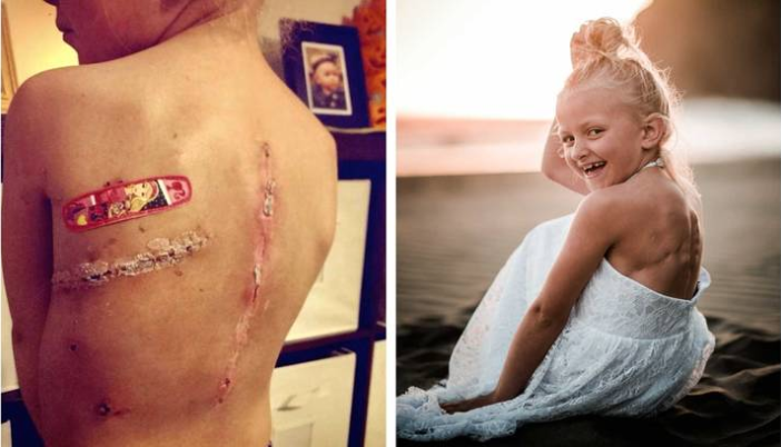 Girl with Cancer Told to Cover Scars