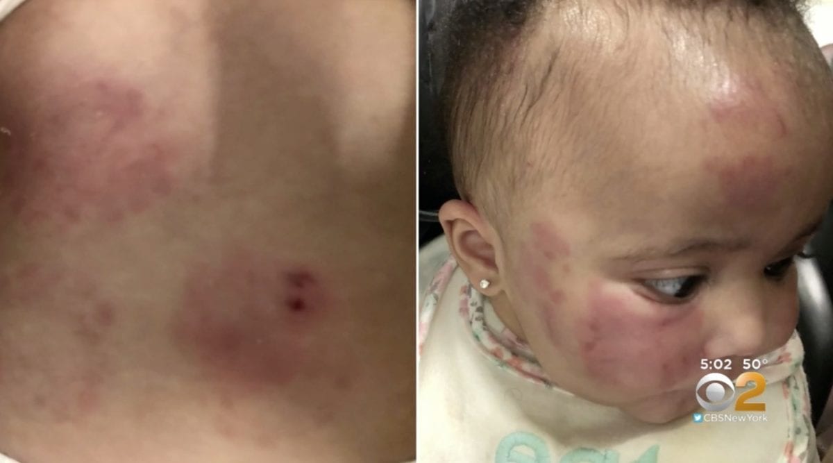 unlicensed new jersey daycare gets shut down after baby is found with bite marks on stomach and bruises on her face