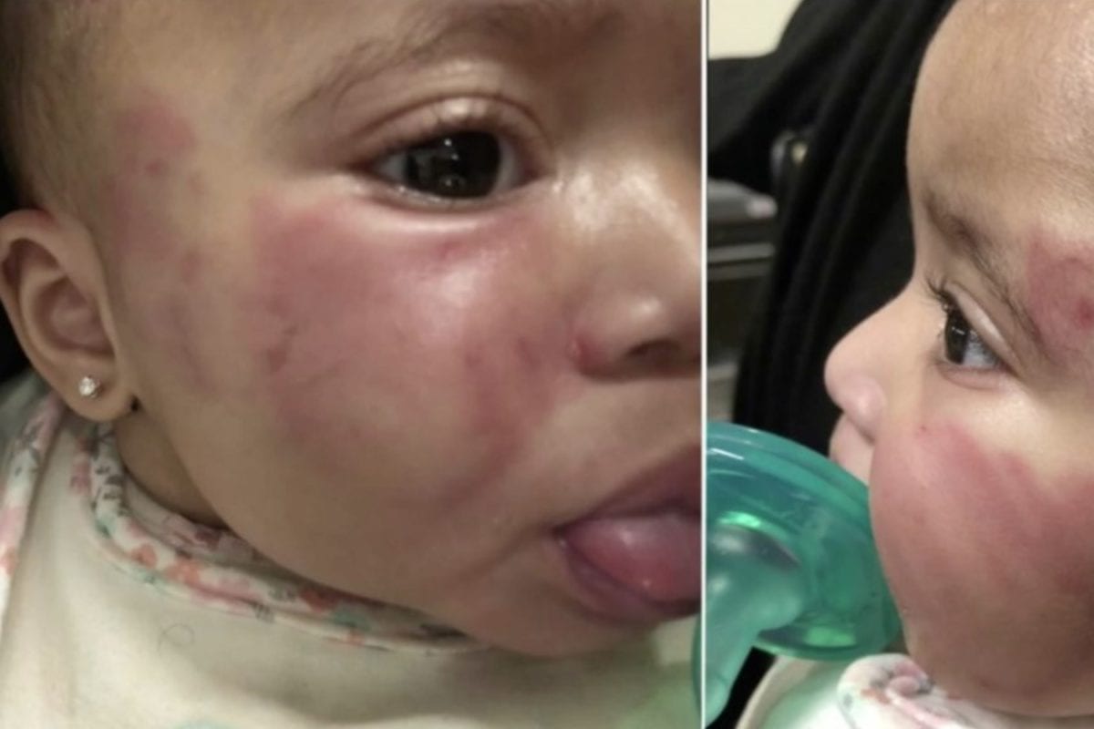 daycare shut down: unlicensed new jersey daycare gets shut down after baby is found with bite marks on stomach and bruises on her face