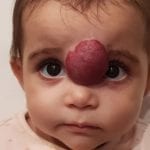 Baby Has Growth Removed From Her Face Just Before Her First Birthday, Now Her Parents Want to Share Her Story for Others