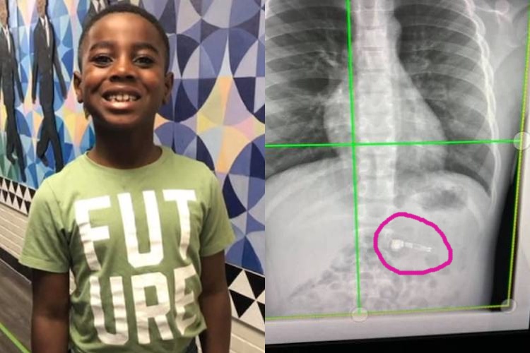 A 7-Year-Old Boy From Georgia Swallowed an Apple AirPod and Had to Be Taken to the Hospital