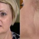 Mom Has Ear Amputated After Getting Skin Cancer Due to Tanning Addiction, Now She Wants Others to Learn From Her Mistakes