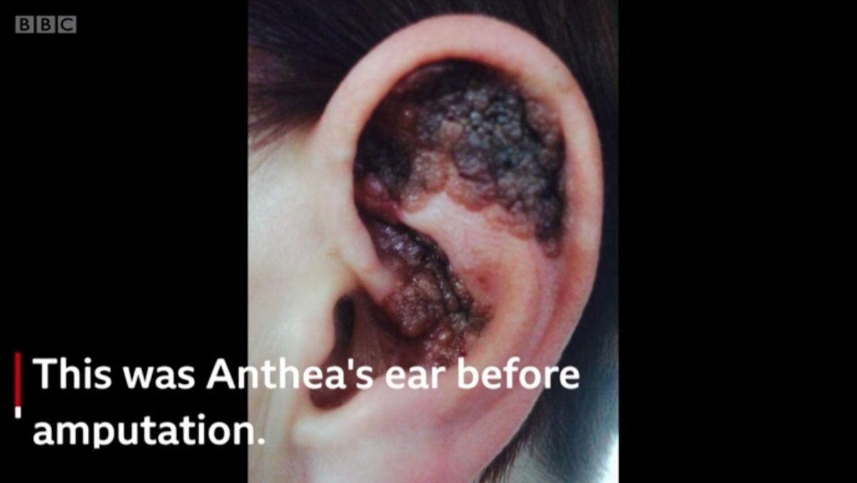 mom shares story after ear is amputated due to tanning addiction