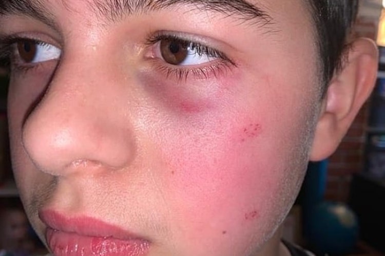 A Teen Boy with Autism Was Beaten and Bullied at School for Months, and Now His Mother Is Speaking Out