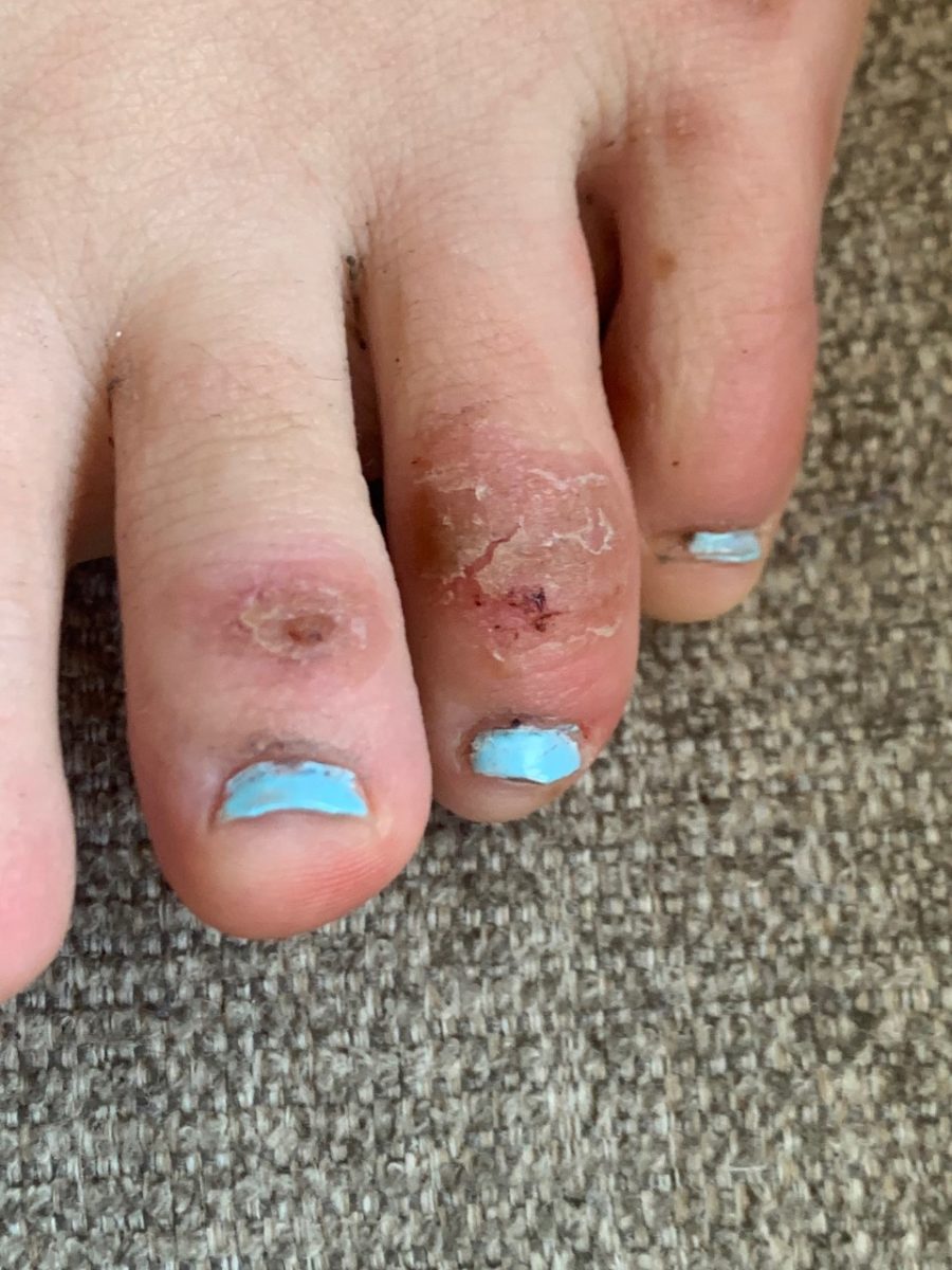 Doctors Say 'COVID Toes' May Potentially Be an Early Symptom for Young People With the Virus | COVID toes “is a manifestation that occurs early on in the disease, meaning you have this first, then you progress."