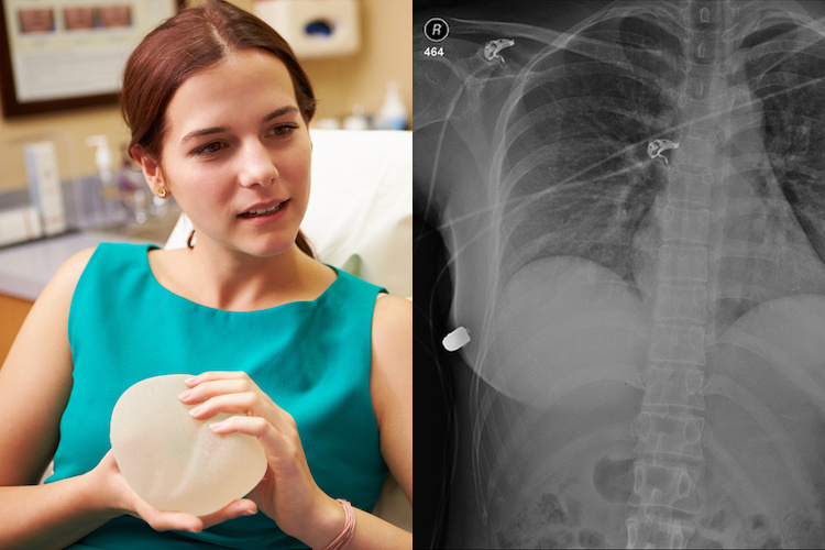 Doctors Say a Woman's Breast Implant Deflected a Bullet and Ultimately Saved Her Life