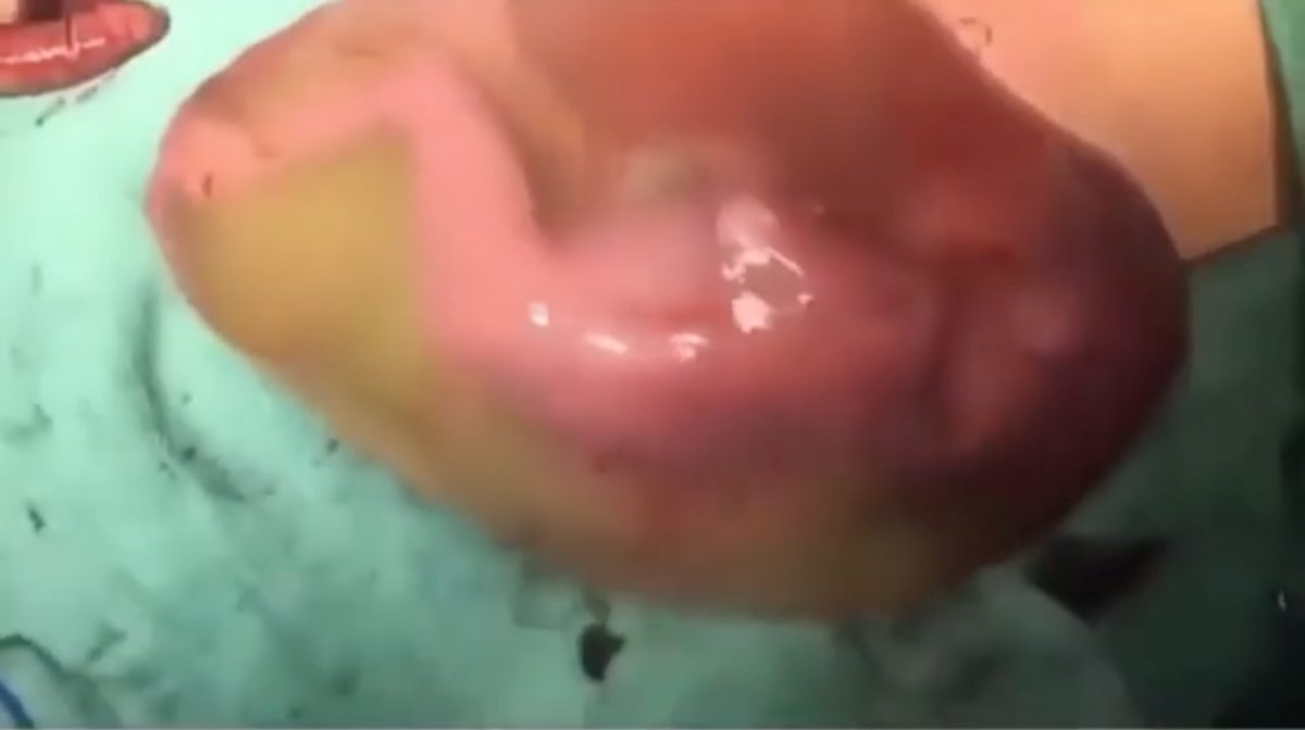 Rare Viral Video Shows Baby Kicking Inside Mother's Amniotic Sac After Being Born