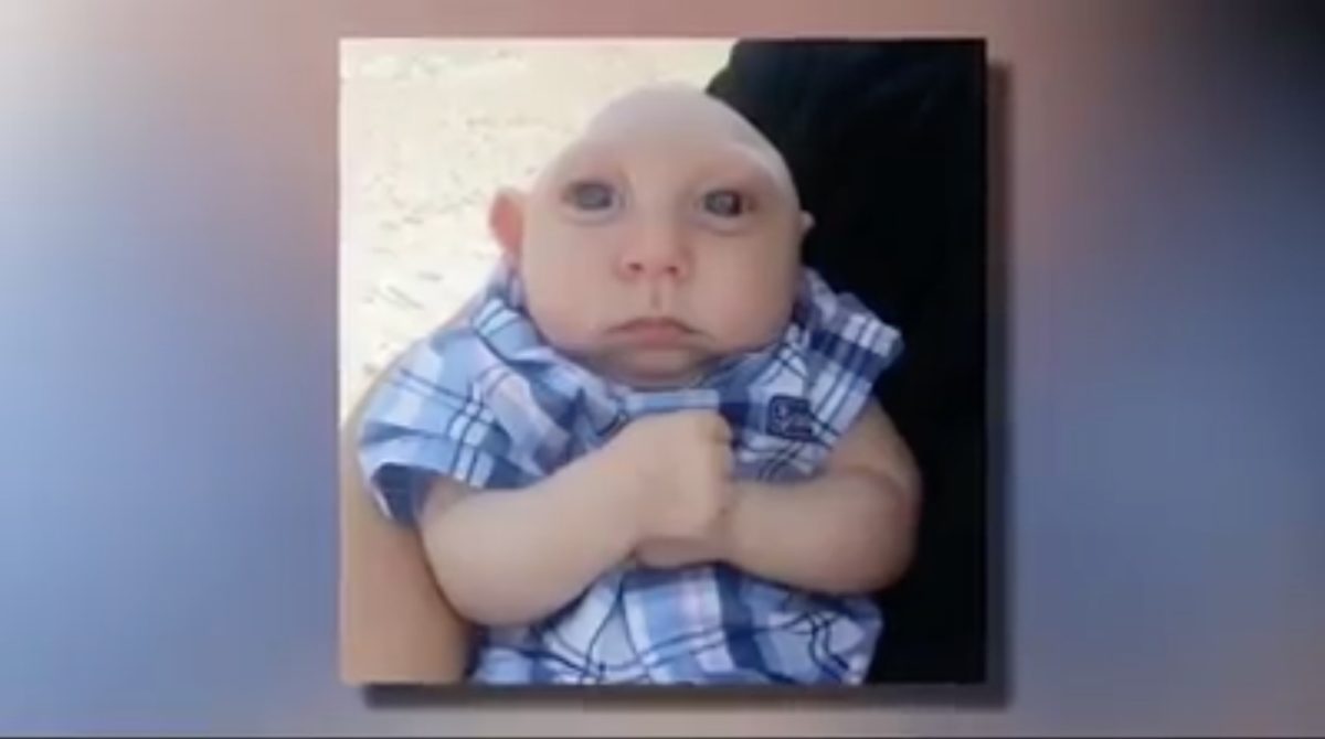 'miracle boy' born without 80-percent of his skull dies at 5