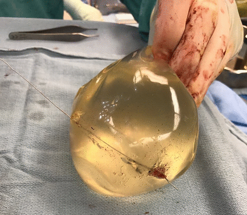 doctors say a woman's breast implant deflected a bullet and ultimately saved her life
