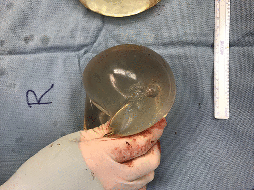 doctors say a woman's breast implant deflected a bullet and ultimately saved her life