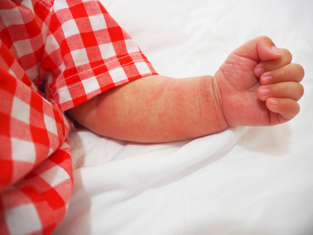 expert advice for a mom whose 2-year-old son recently developed a skin allergy