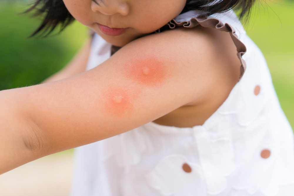 What Are the Best Tips to Keep My Kids Safe from Mosquitos and Other Bugs?