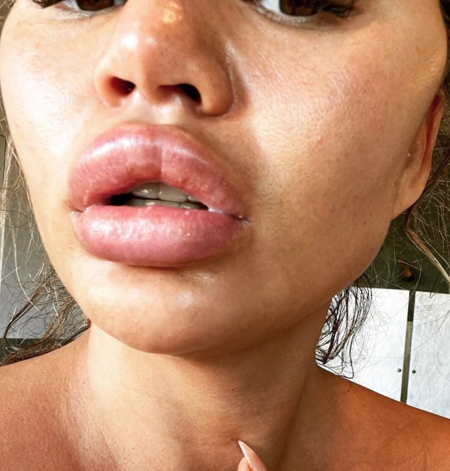 chrissy teigen posts swollen lips, insists it's not filler