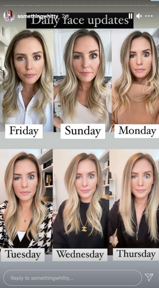 Influencer Whitney Buha Shows Side Effect Of Getting Botox