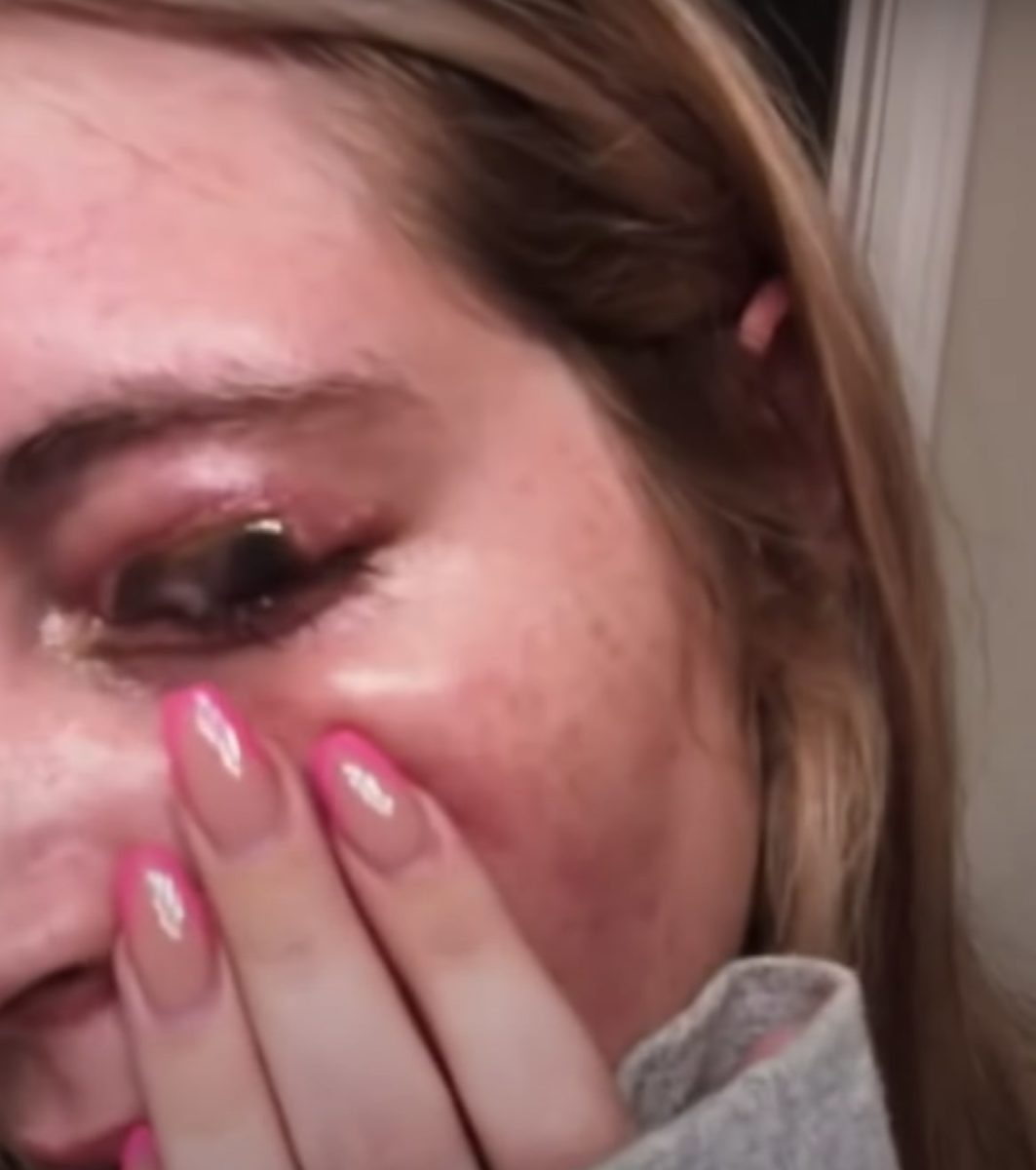 23-Year-Old Woman Gets Eyelid Ripped Off By Her Lash Technician's Chihuahua