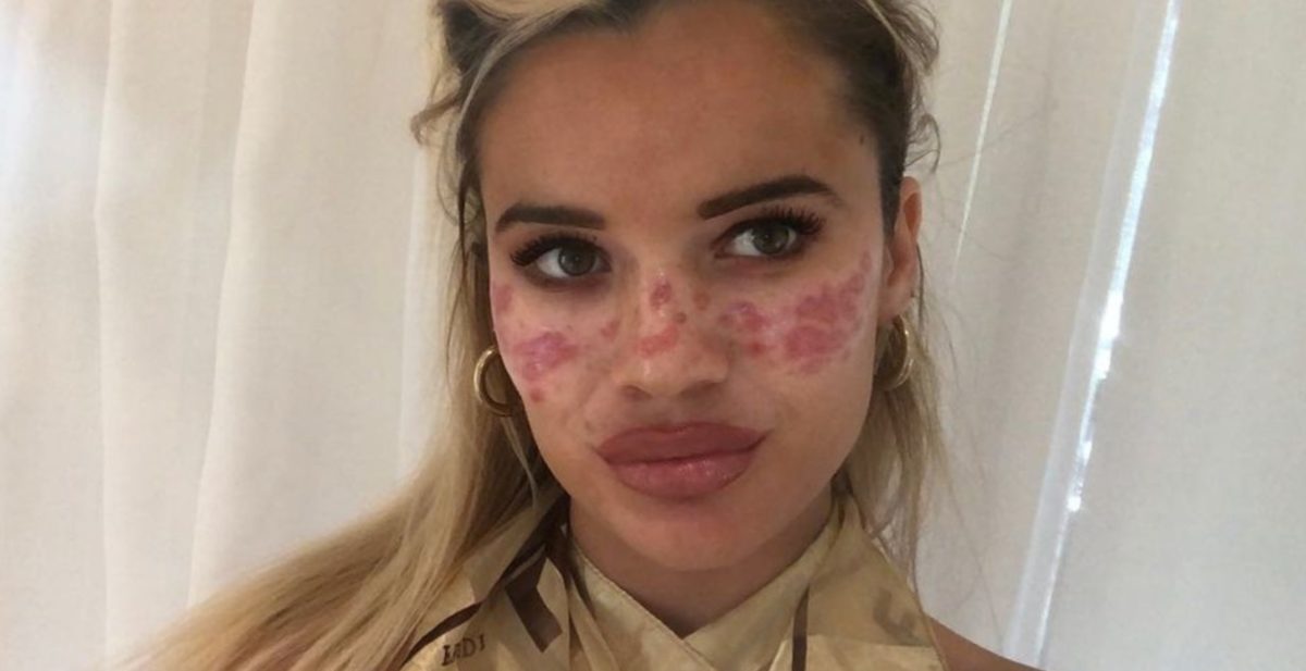 Big Brother's Tilly Whitfeld Says TikTok Beauty Hack Caused Her Severe Scarring and Vision Loss