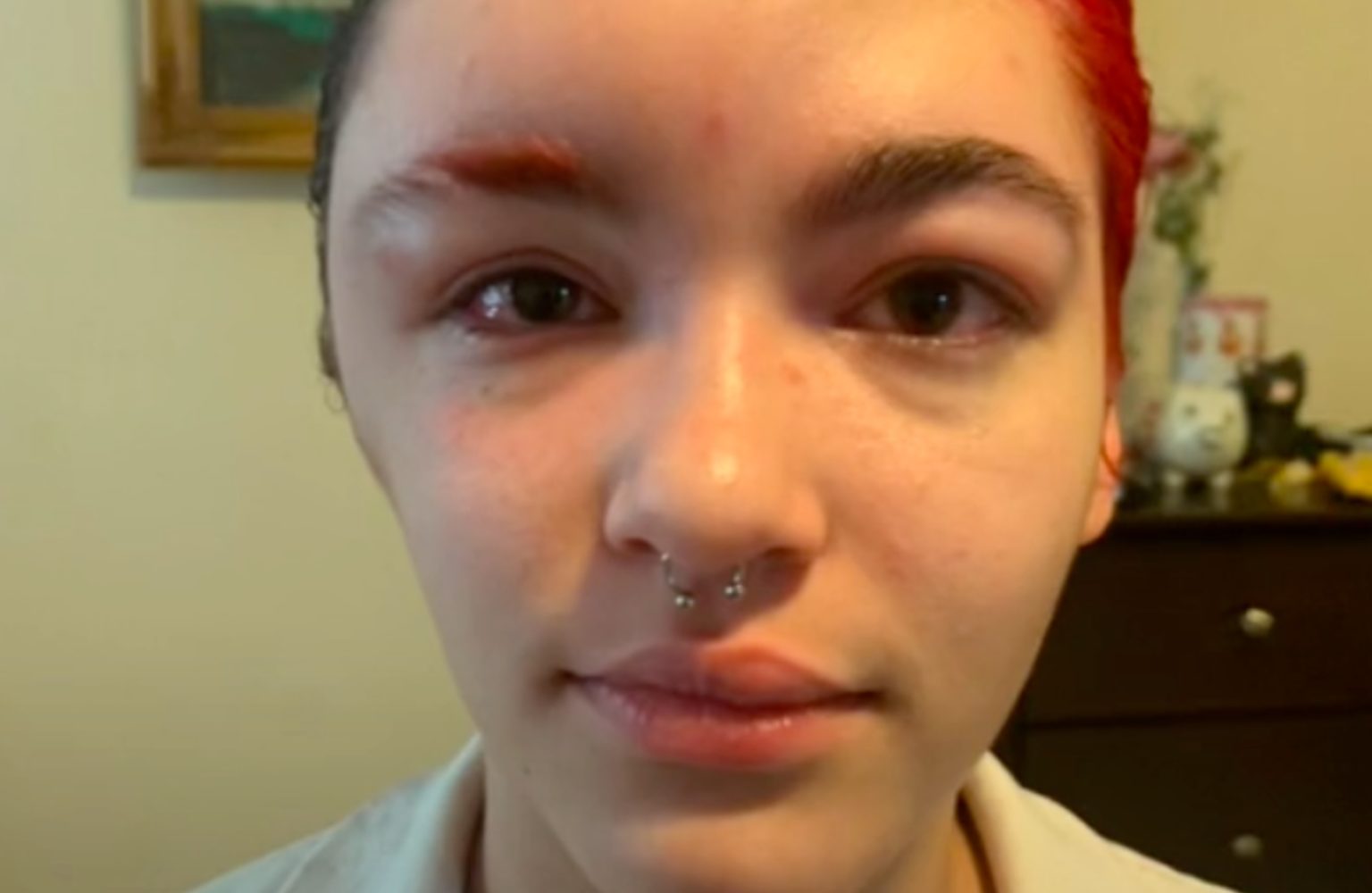 19 Year Old Goes Viral After Allergic Reaction To Hair Dye