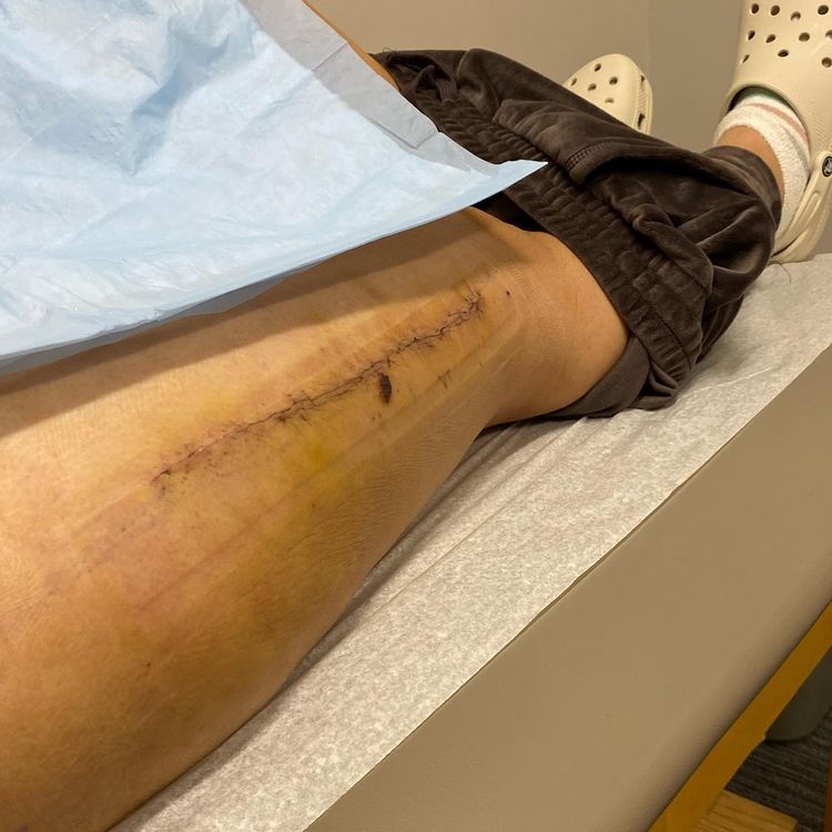 a woman's spin class caused her to go into emergency surgery and almost lose a leg