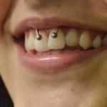 Ever Heard of a Smiley Piercing? Here Are 25 Pictures