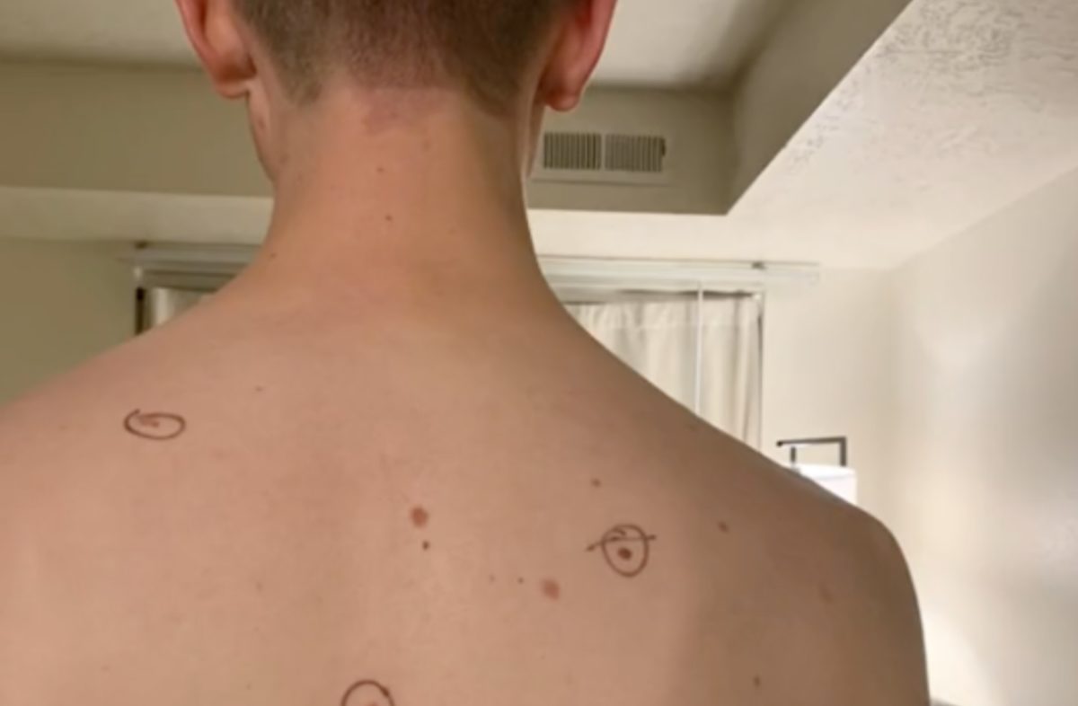 tiktok wife goes viral for sending husband to dermatologist with circles around his concerning moles, doctor leaves notes for her