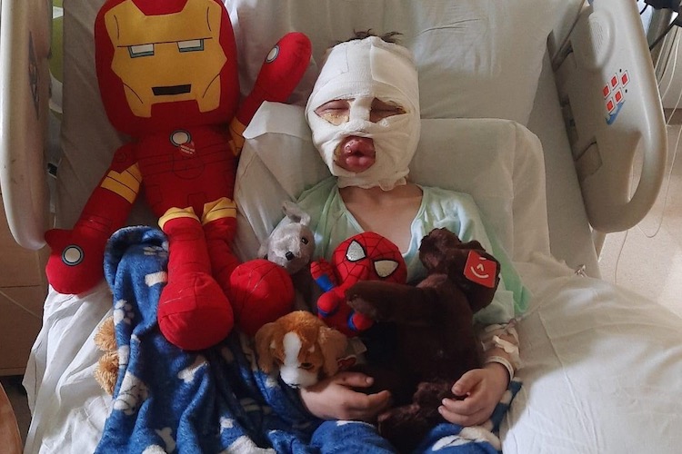 6-Year-Old Boy Suffers Third-Degree Burns After Bully Threw Fireball at His Face