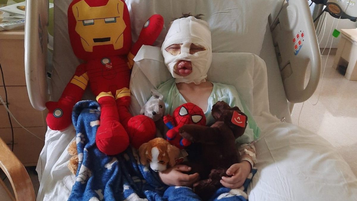 6-year-old boy suffers third-degree burns after bully threw fireball at his face