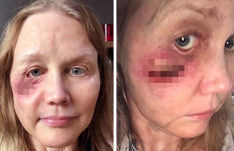 Woman Tries Cosmetic Fillers, Creates Massive Hole In Face Years Later
