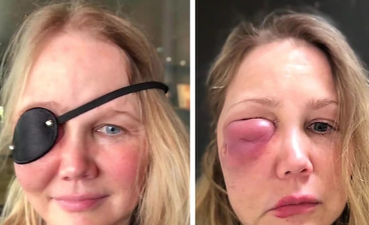woman tries cosmetic fillers, creates massive hole in face years later