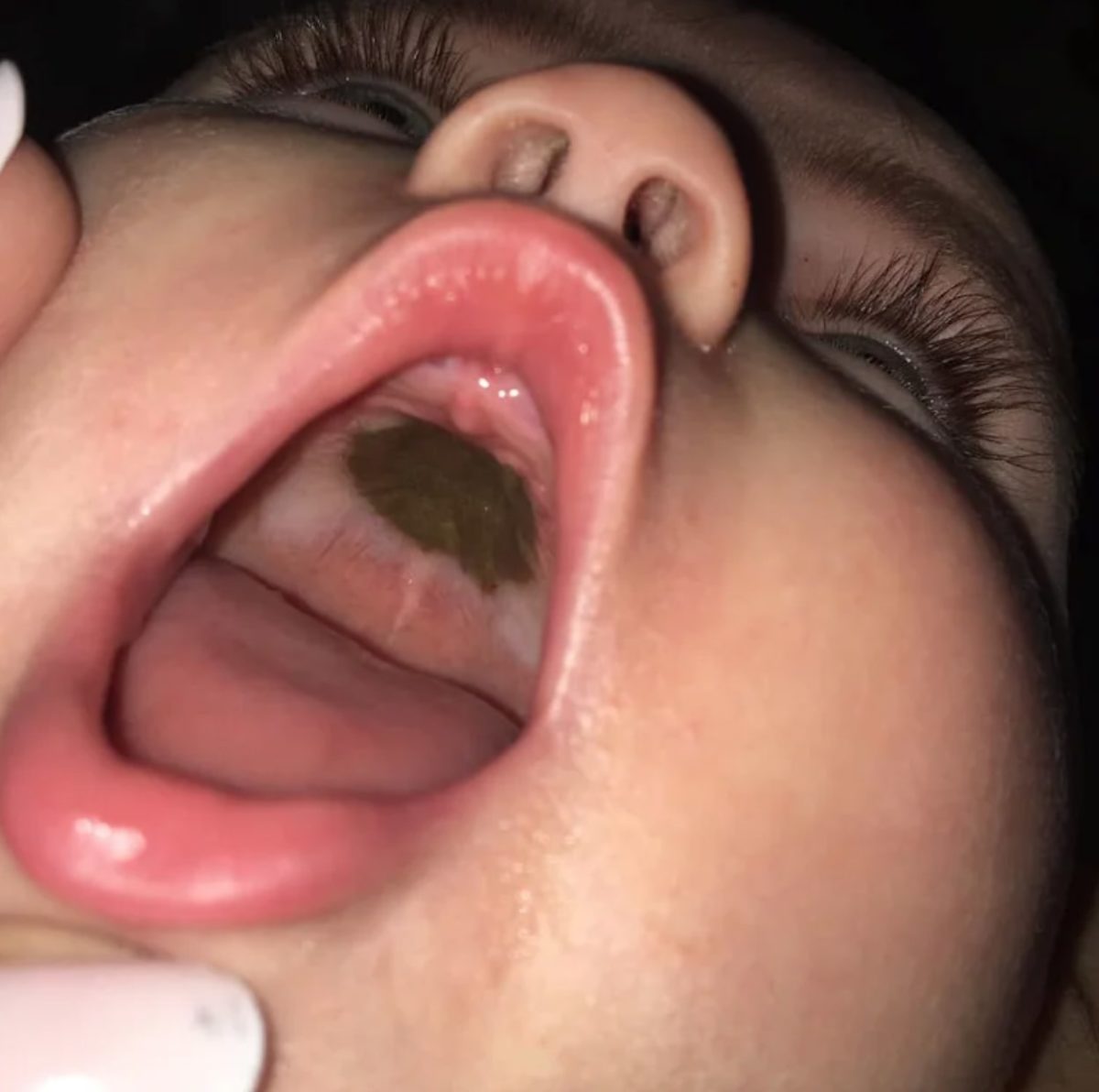 mom stumped by mysterious mark in daughter's mouth