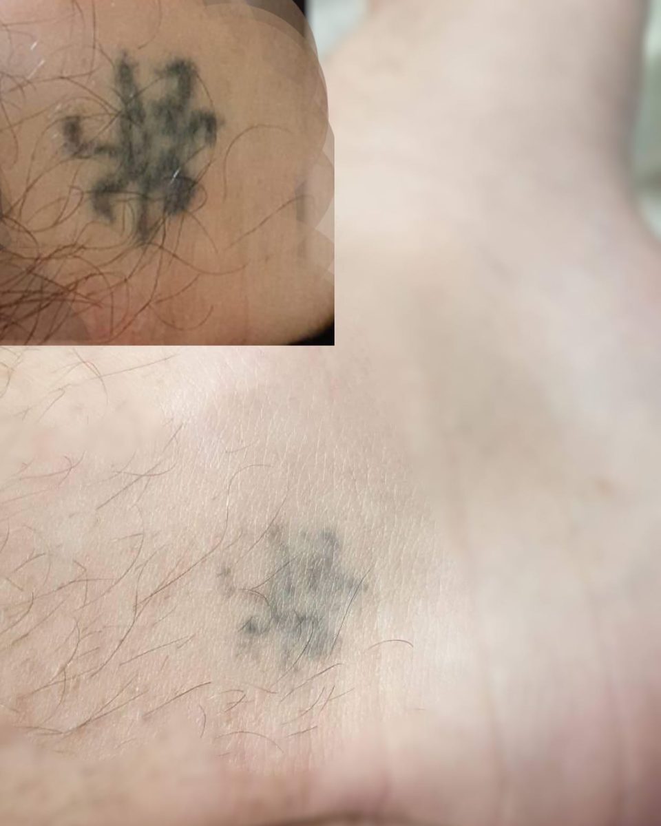 Tattoo Removal Before and After 