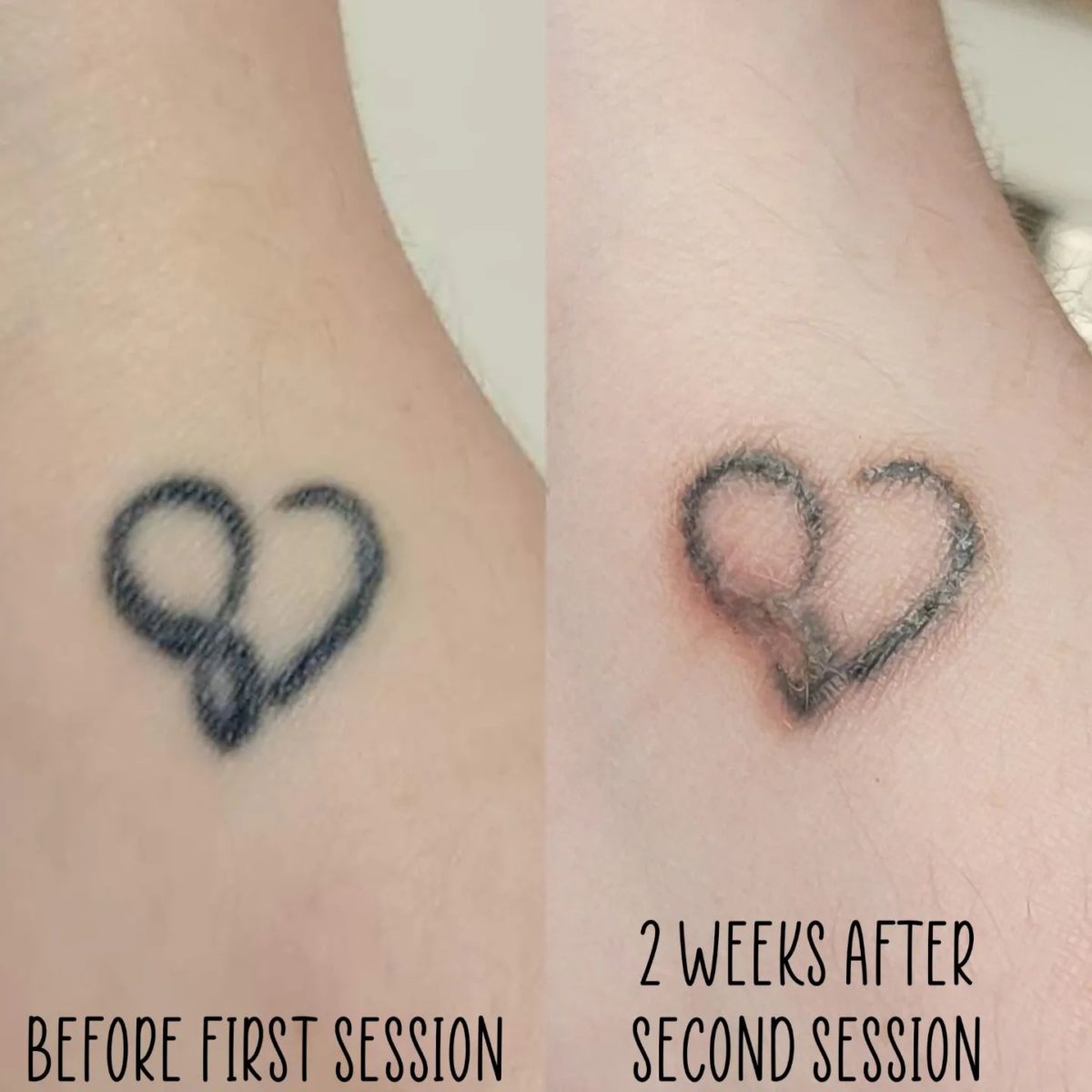 Have you ever wondered what the most common tattoos we remove are   LaserTat