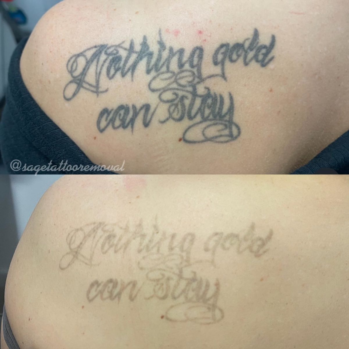 tattoo removal before and after 