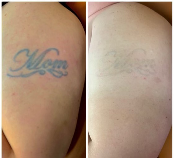25 Tattoo Removal Before And After Photos