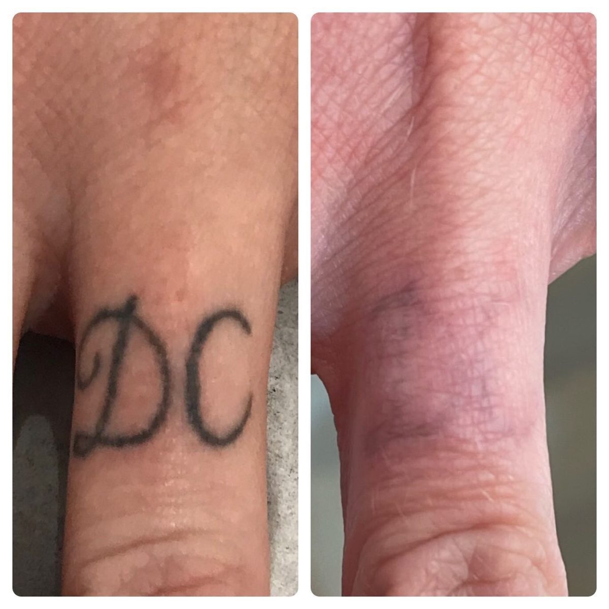 Tattoo Removal Before and After 