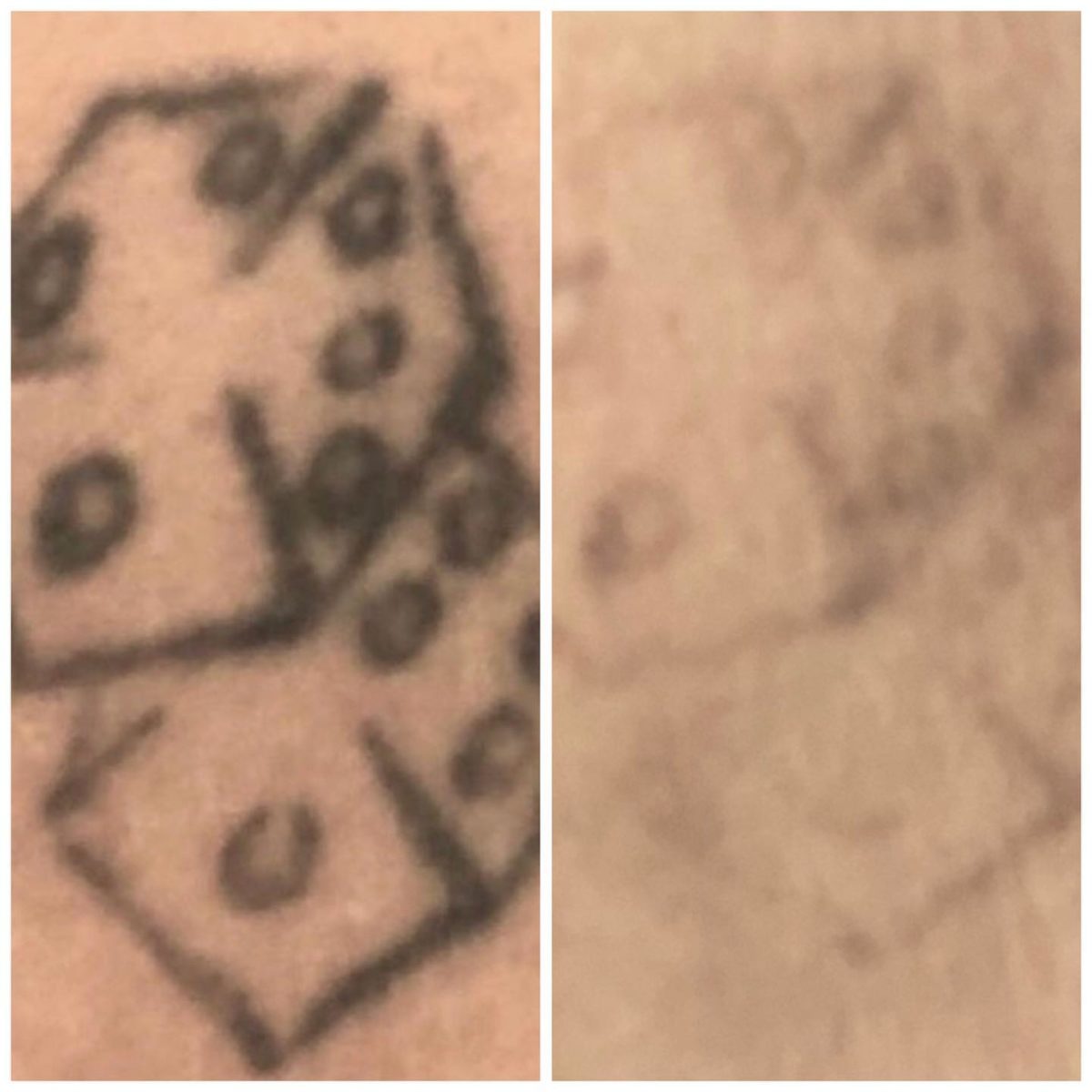 tattoo removal before and after 