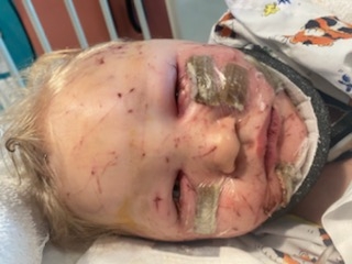 Parents Share Warning About ‘Littermate Syndrome’ After Toddler Suffers Gruesome Injuries in Puppy Attack 1