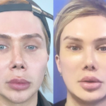 Influencer and Plastic Surgery Fanatic, Oli London, Announces His Intent to Detransition Back to Male